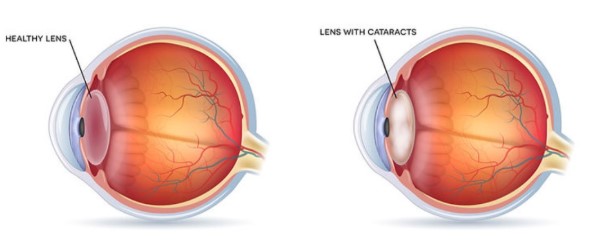 cataract